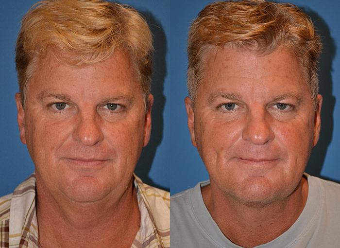 Male Neck Lift Photos Melbourne, FL Patient 29290